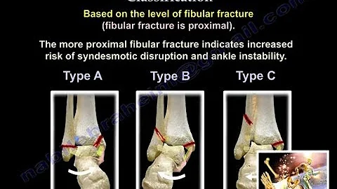 Ankle Fractures Danis Weber Classification - Every...