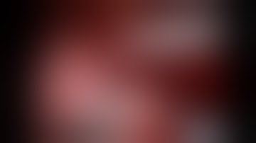 Robotic Assisted Partial Nephrectomy (RAPN) with zero ischaemia by Prof. Dr. Mottrie (short video)