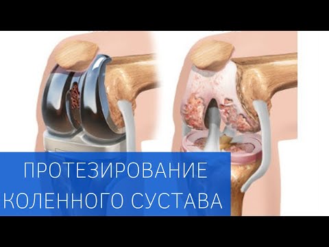 Протезирование коленного сустава, программа реабилитации