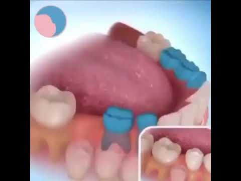 Последствия раннего удаления молочного зуба