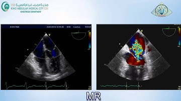 010 Mitral Regurgitation TEE KAMC