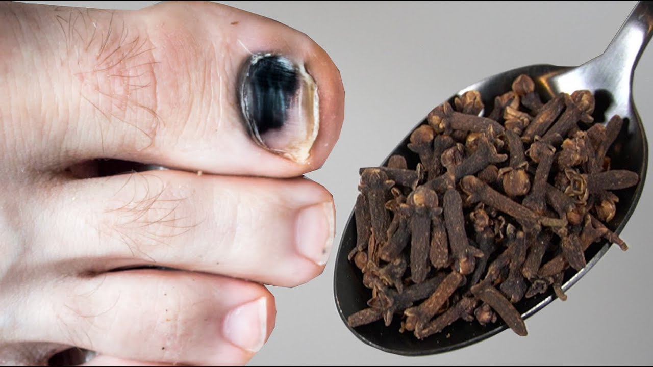 Cure Toenail Fungus For Less Than 1 / Have Toenail Fungus? You must do