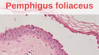 Pemphigus Foliaceus - Pathology mini tutorial screenshot 4