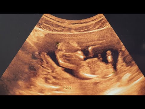 Vídeo: 12 Semanas De Gravidez: Sensações, Desenvolvimento Fetal, Ultrassom