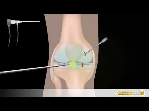 Kniearthroskopie: So läuft eine Gelenkspiegelung des Kniegelenks ab