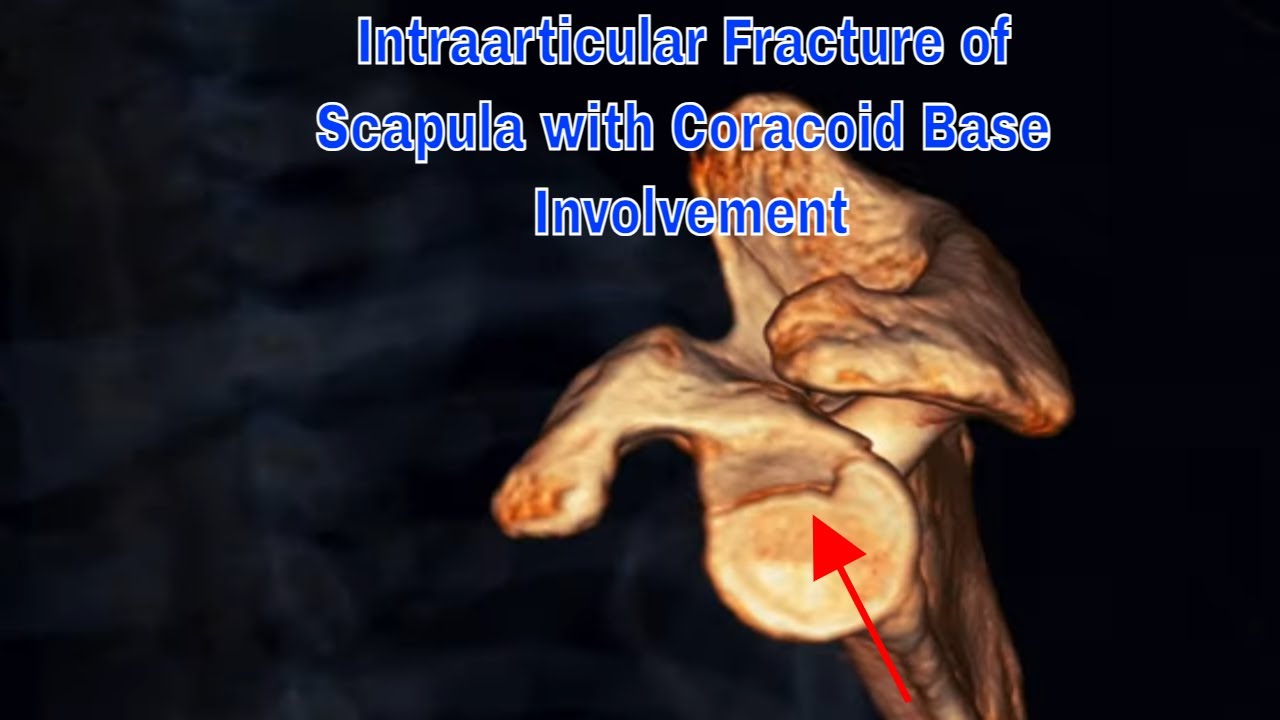 Intraarticular Fracture of Scapula with coracoid base involvement