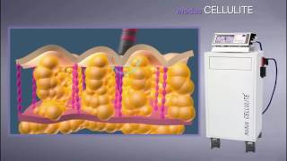 MODUS CELLULITE  AWT (Acoustic Wave Therapy)