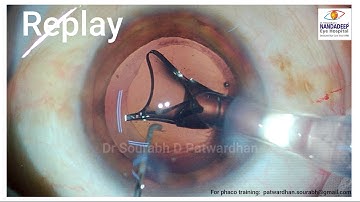 What will you do Next? Posterior capsular rupture Dr Sourabh Patwardhan