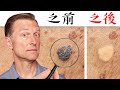 一天快速消除瘜肉和肉疣自然療法,柏格醫生 Dr Berg