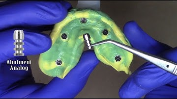 Laboratory Technique for F-Tx Prostheses Placing Analogs & Pouring Stone Models
