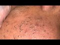 Extra time remove black head