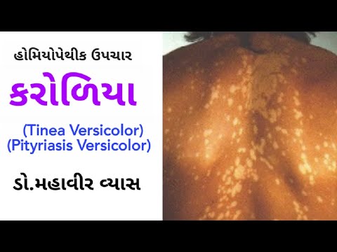 કરોળિયા : કારણો, લક્ષણો અને હોમિયોપેથીક ઉપચાર : ડો.મહાવીર વ્યાસ