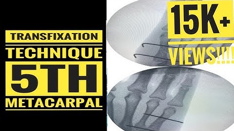 5th Metacarpal Fracture Transfixation technique