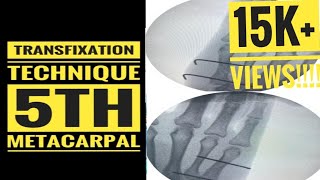 5th Metacarpal Fracture Transfixation technique