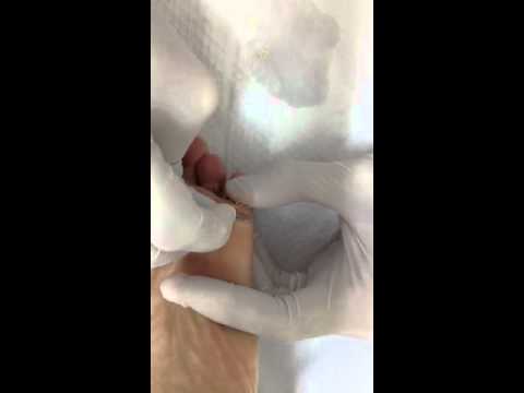Natural W Get Rid Of Feet Calluses Natural W Get Rid Of Feet Calluses