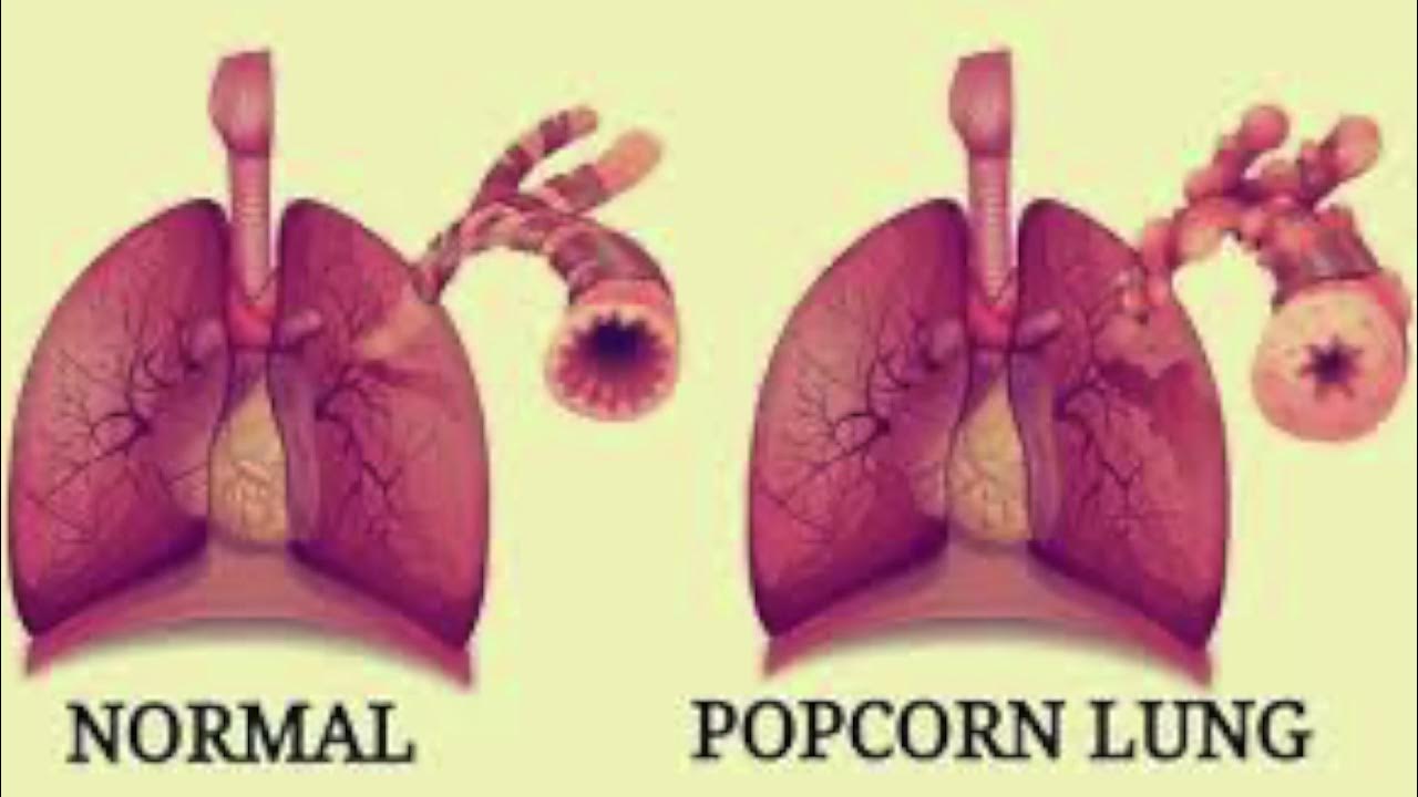 Escape the Vape Popcorn Lung YouTube