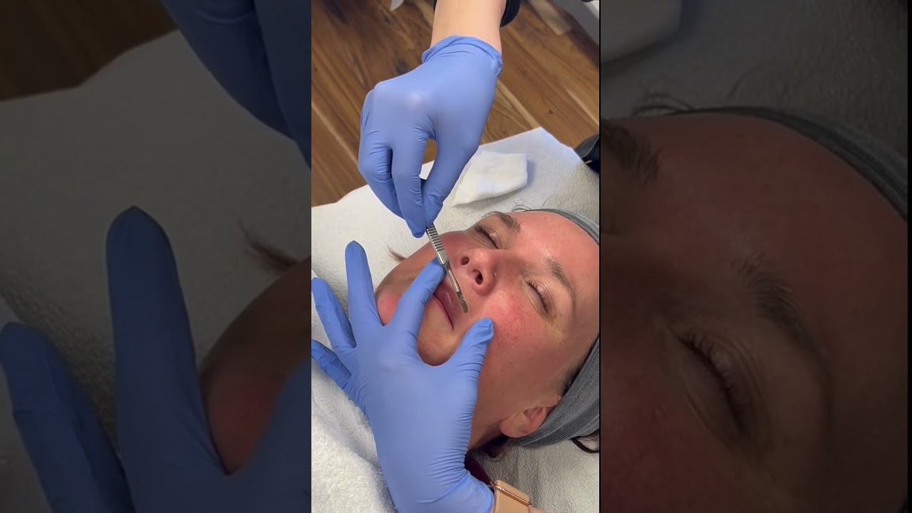 Dermaplaning Treatment! 