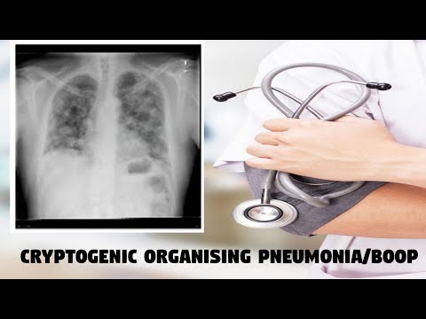 Cryptogenic organising Pneumonia | BOOP