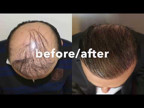 Hair Transplant Repair | HLC - Experts in Hair Restoration