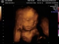 Baby Lee - 3D Ultrasound (1/21/17)