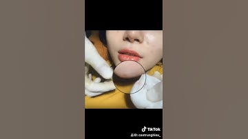 Tiêm Filler bị lỗi