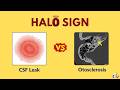 Halo Sign in ENT explained | CSF Leak vs Cochlear Otosclerosis
