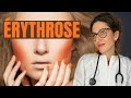 Causes et traitements de lrythrose les rougeurs du visage