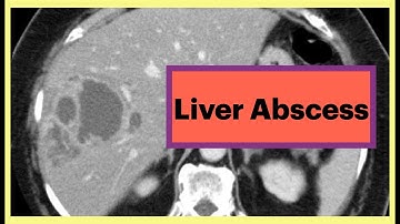 Liver Abscess Radiology #Radiology #Liver #Surgery