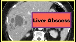 Liver Abscess Radiology