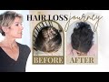 Hair Loss in Women: Dr. Approved Treatments, Shampoos & Thin Hair Hairstyles Tips | Dominique Sachse