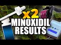 How To Double Your Minoxidil Results (IMPORTANT FOR NON-RESPONDERS)