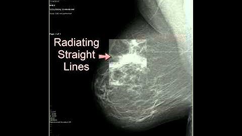 Breast Imaging Boot Camp: Arch Distortion