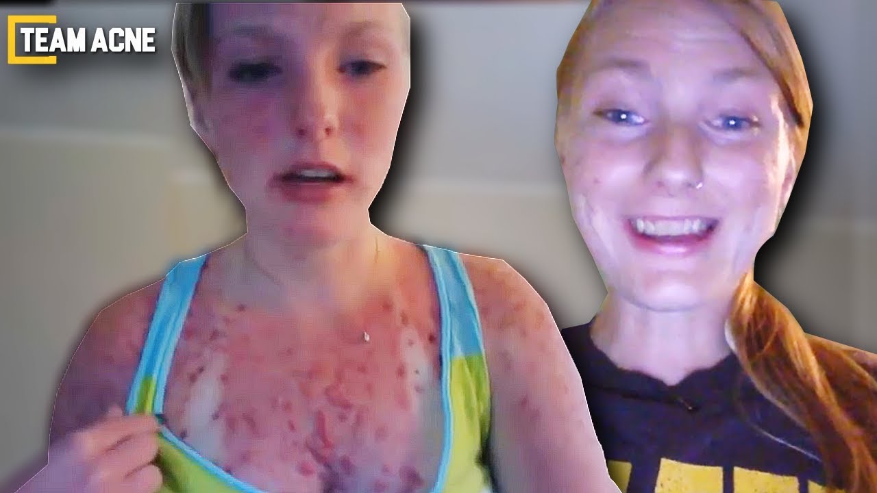Why I'm Ending Accutane Early (SUNBURN) MY REACTION YouTube
