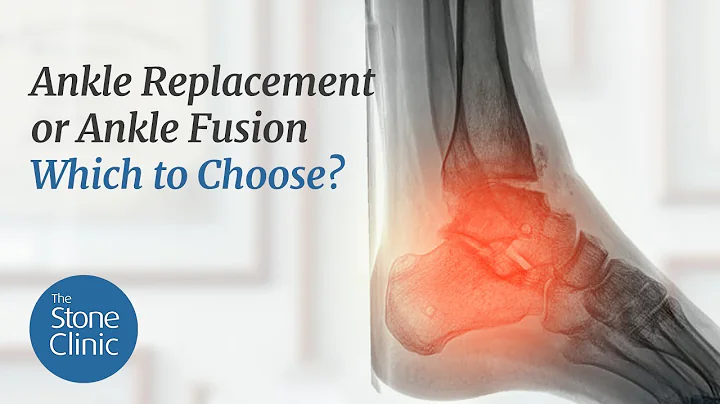 Ankle Replacement or Ankle Fusion. Which to Choose?