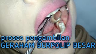 Pencabutan Gigi Bawah Berlubang|Polip Gigi Geraham|Tooth Extraction. 