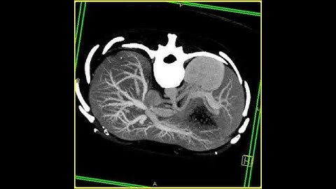 Abdomen: Liver: Hepatic veins: 3D mapping using volume rendering and MIP