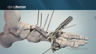 DynaBunion™ 4D Minimal-Incision Lapidus System - Narrated Animation