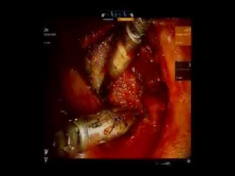 Transoral Robotic Surgery:  Glossotonsillar Sulcus.  Johns Hopkins Hospital