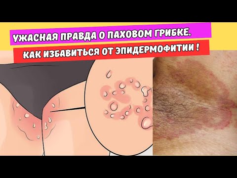 Ужасная правда о паховом грибке.Как избавиться от эпидермофитии !