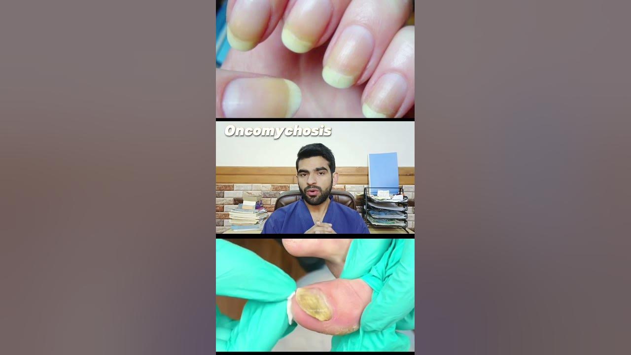 Why does my nails turn yellow Yellowish discoloration of Nails YouTube