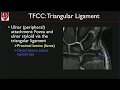 Mri of the wrist ligaments and triangular fibrocartilage complex by michelle nguyen md