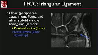 MRI of the Wrist: Ligaments and Triangular Fibrocartilage Complex, by Michelle Nguyen, MD