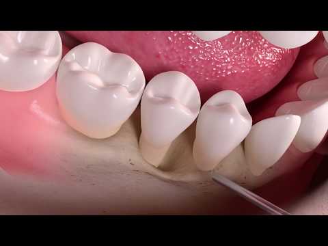 Video: Definování Funkčních Podpisů Dysbiózy V Progresi Parodontitidy