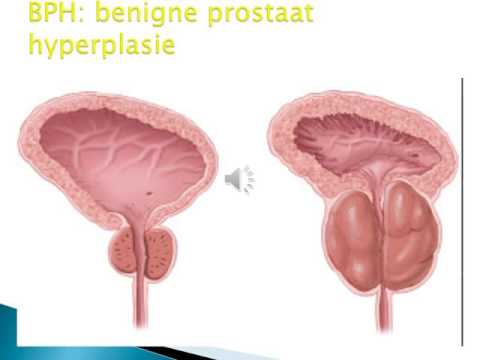 Video: Goedaardige Prostaathyperplasie