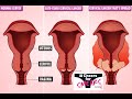 What Is Cervical Cancer