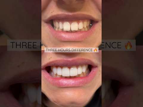 Composite bonding by