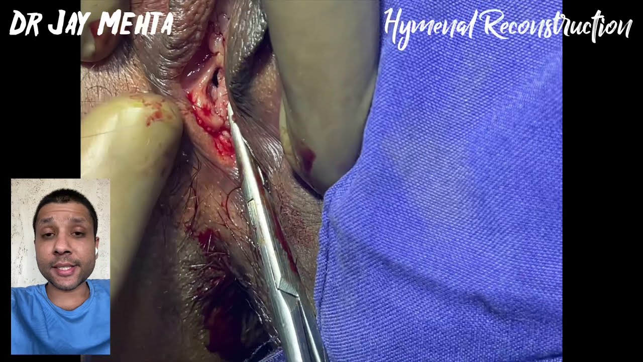  Hymenal Reconstruction | Re-Virginity Surgery | Hymenoplasty | Cosmetic Gynecology | Dr Jay Mehta