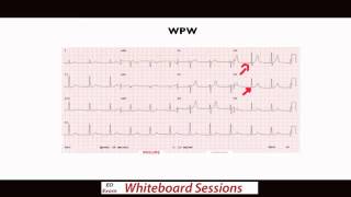EDExam Whiteboard Session: Don't Miss These ECG's Part 1