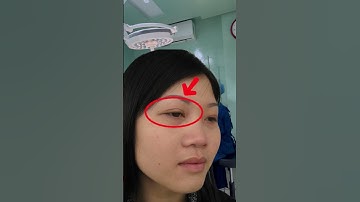 Cắt mí plasma Dr.Kiem  #shortsfeed #shorts #shortsvideo #catmimat