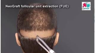 زراعه الشعر بتقنيه fue